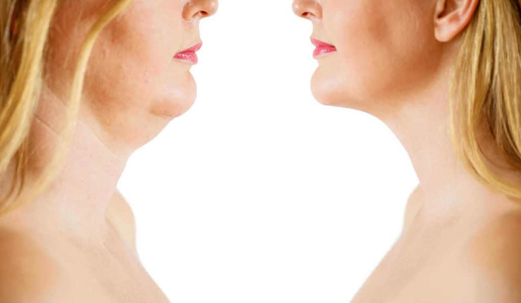 Double Chin treatment Buckinghamshire before and after results