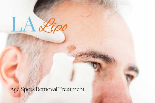 What Are the Most Effective Treatments for Age Spots Buckinghamshire?