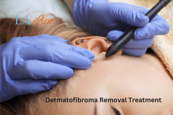 Dermatofibroma Removal Treatment Buckinghamshire