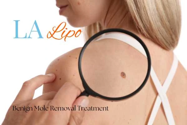 Woman having her inspection of blemish before mole removal Buckinghamshire