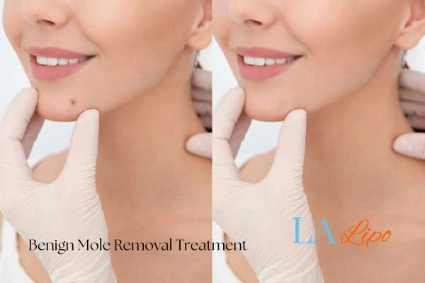 Before and after mole removal Buckinghamshire treatment