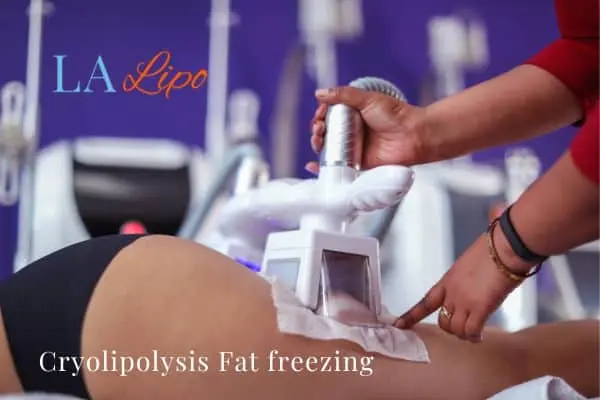 women getting fat freezing Buckinghamshire
