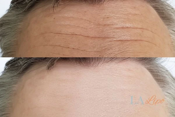 results of HIFU Buckinghamshire on mans forehead to help reduce lines and wrinkles