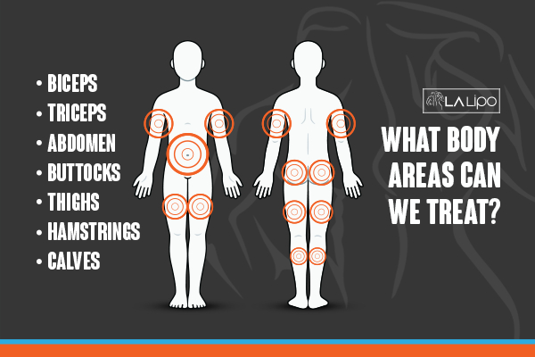 Graphic to show areas you can have LA-EMS Body Sculpting Buckinghamshire treatment.