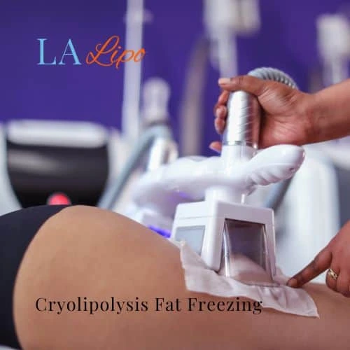 fat freezing - Cryolipolysis Buckinghamshire