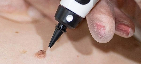 skin tag removal using cryopen Buckinghamshire