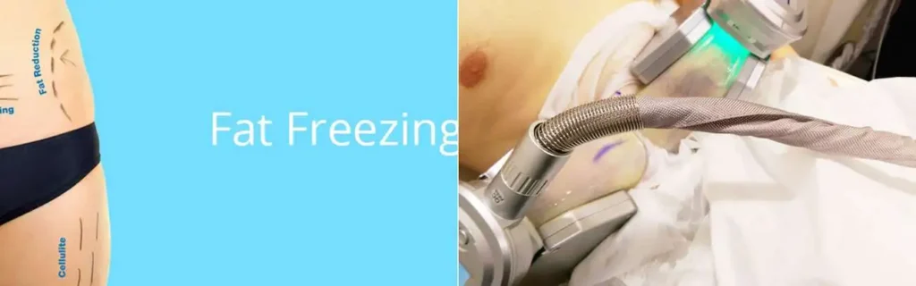 multi areas of a persons body having coolsculpting Buckinghamshire treatment