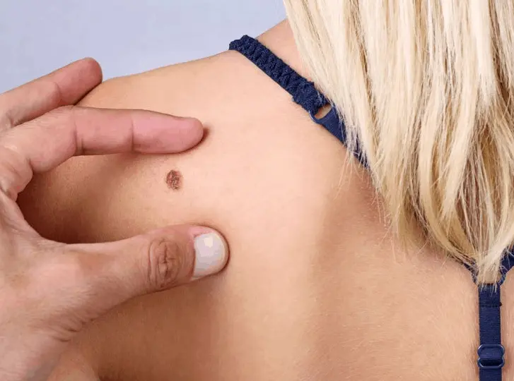 woman having mole removal Buckinghamshire consultation before treatment.