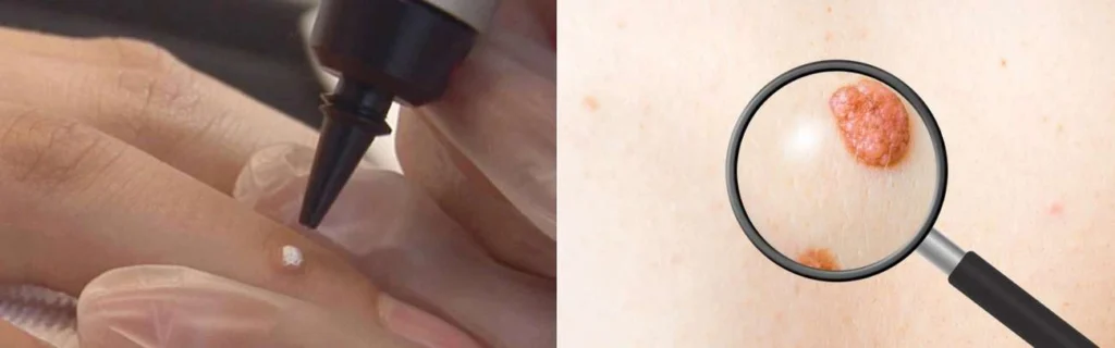 Person getting moles removed with cryopen Buckinghamshire