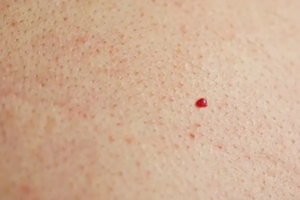 close up of a cherry angioma Buckinghamshire