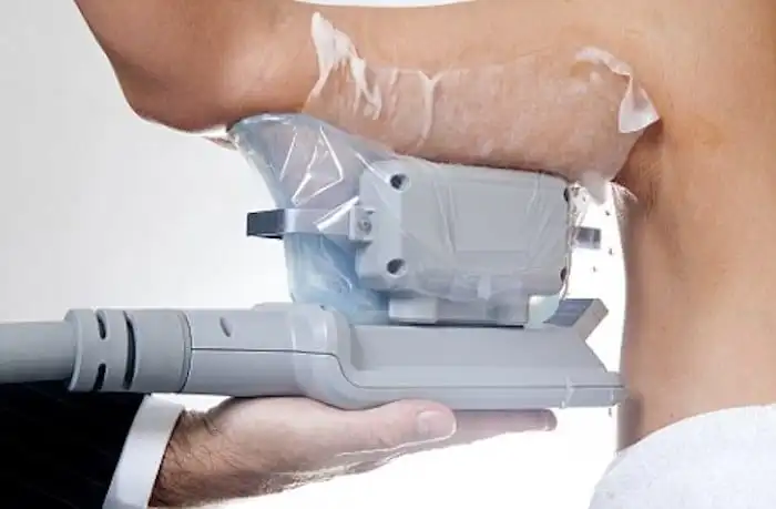 Picture of fat freezing Buckinghamshire on the upper arms.