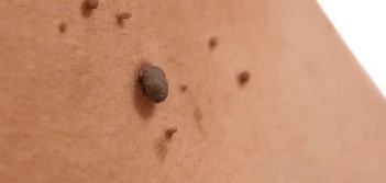 image of a skin tag Buckinghamshire
