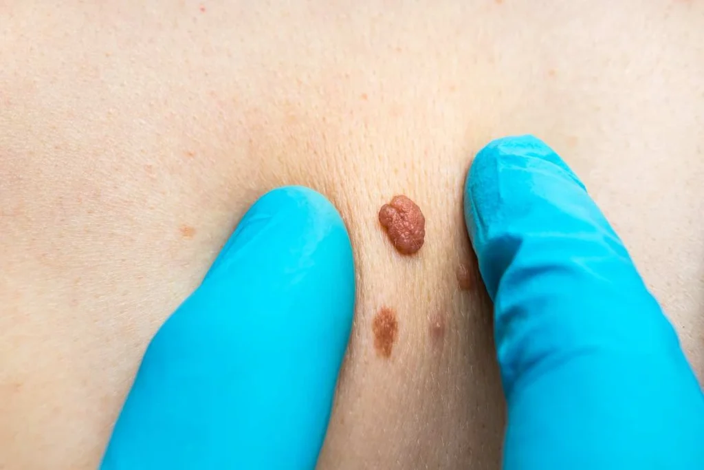 Consultant examining a skin tag Buckinghamshire