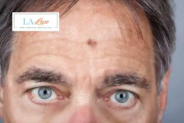 Solar Lentigo Removal Buckinghamshire image of man with mark on his forehead