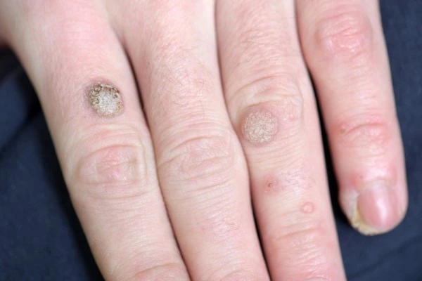 photo of warts on person hand - see wart removal Buckinghamshire from LA LIPO
