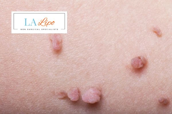 Does cryopen skin tag removal Buckinghamshire hurt? Find out now call our team today!