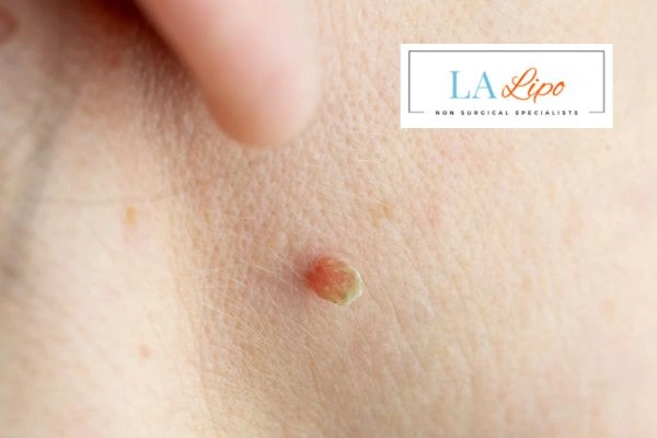 Book skin tag removal Buckinghamshire today speak to our team now!