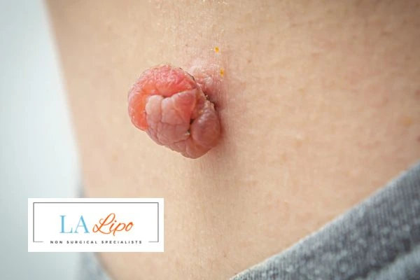 Interested in skin tag removal Buckinghamshire? Concerned about the pain? Find out more today!