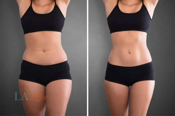 before and after results of non-surgical treatment to help a woman's body image and mental health Buckinghamshire