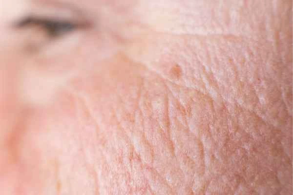 close up picture of a woman's face showing an age spot Buckinghamshire