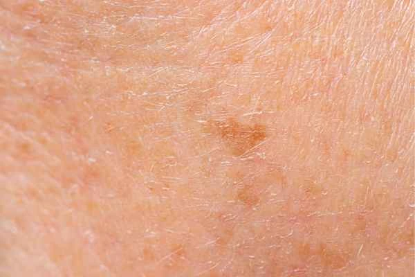 close up picture of age spots Buckinghamshire