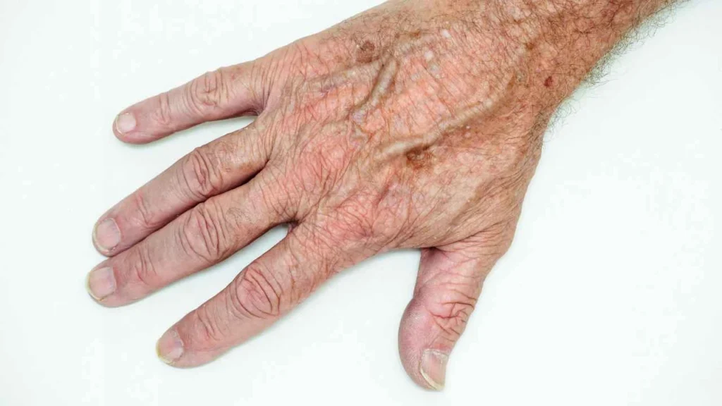Male hand showing age spot Buckinghamshire