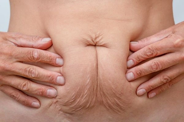 Image of a woman's stomach with loose skin - example of skin tightening Buckinghamshire options
